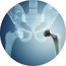 arthroplastiki-isxiou-modern-orthopedics-orthopedikos-larisa